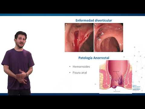 Vídeo: Sangrado Gastrointestinal: Causas, Síntomas Y Diagnóstico