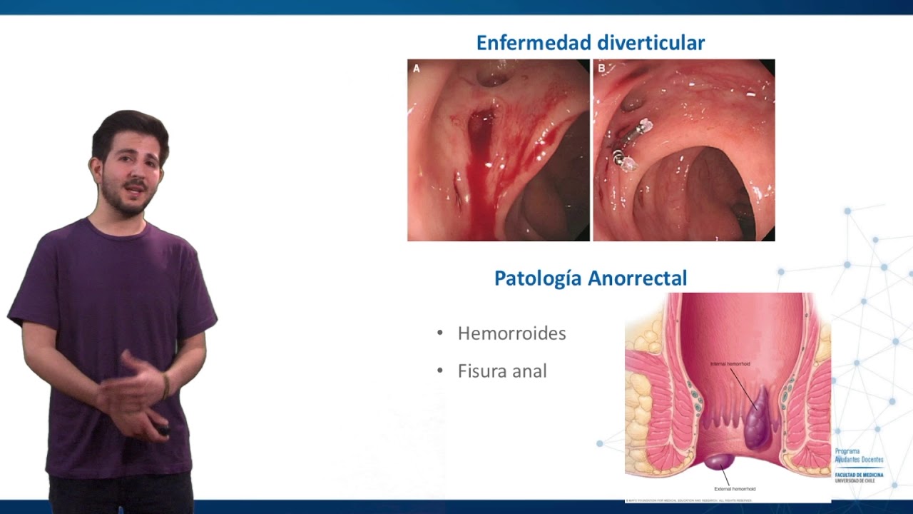 Hemorragia interna con enfermedad hepática
