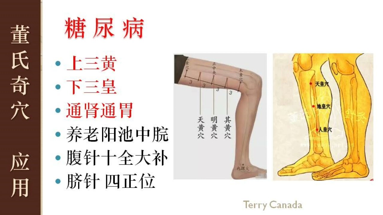 4.2 糖尿病 上三黄+下三皇 | 董氏奇穴, 林君, Master Tung Acupuncture Points - YouTube