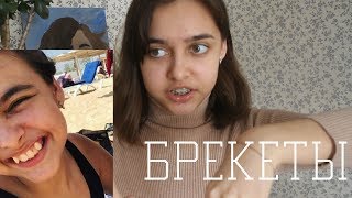БОЛЬНО ЛИ СТАВИТЬ БРЕКЕТЫ ? /Как изменились зубы за два месяца? / моя история БОЛЬНО ЛИ СТАВИТЬ БРЕКЕТЫ ? /Как изменились зубы за два месяца? / моя история