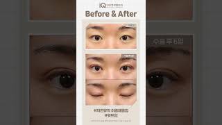 자연유착쌍꺼풀 [아이큐 쌍수 후기]