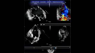 Double inlet left ventricle#echocardiography #cardiologytraining