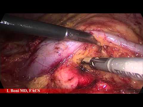 Laparoscopic Living Donor Left Nephrectomy for Transplant