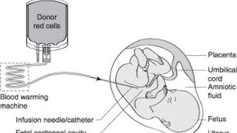 Intrauterine transfusion IUT medical procedure provides blood to a fetus; How it works, procedure