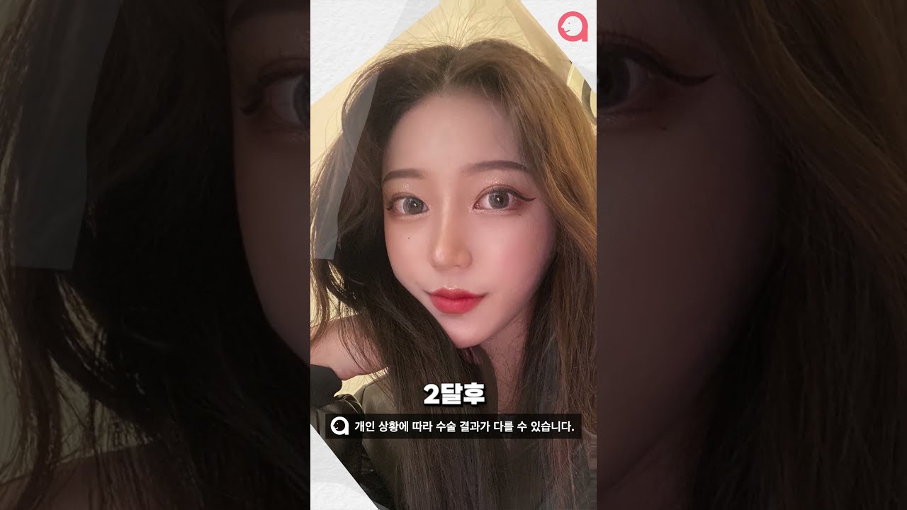 [Эйтоп Гоо Сайхны Мэс Заслын Эмнэлэг] Хамар болон Үнэгэн Контур Мэс Заслын Сэтгэгдэл #shorts