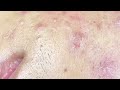 Acne And Blackheads | Mụn Viêm Và Mụn Đầu Đen - SacDepSpa#298