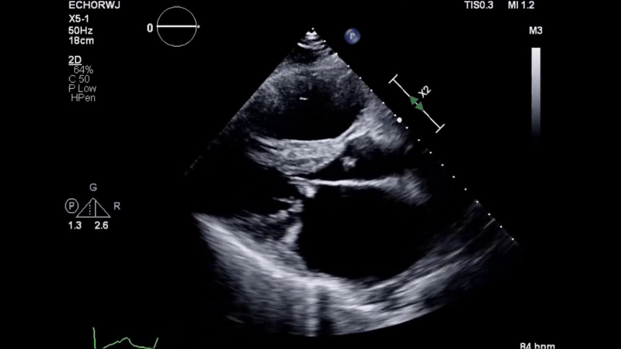 Mitral Stenosis Rheumatic Heart Disease: ParaSternal Long mitral valve