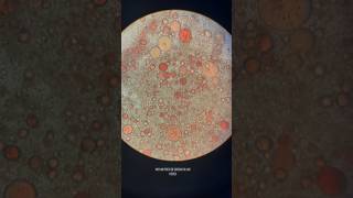 Grasas Neutras Positivo