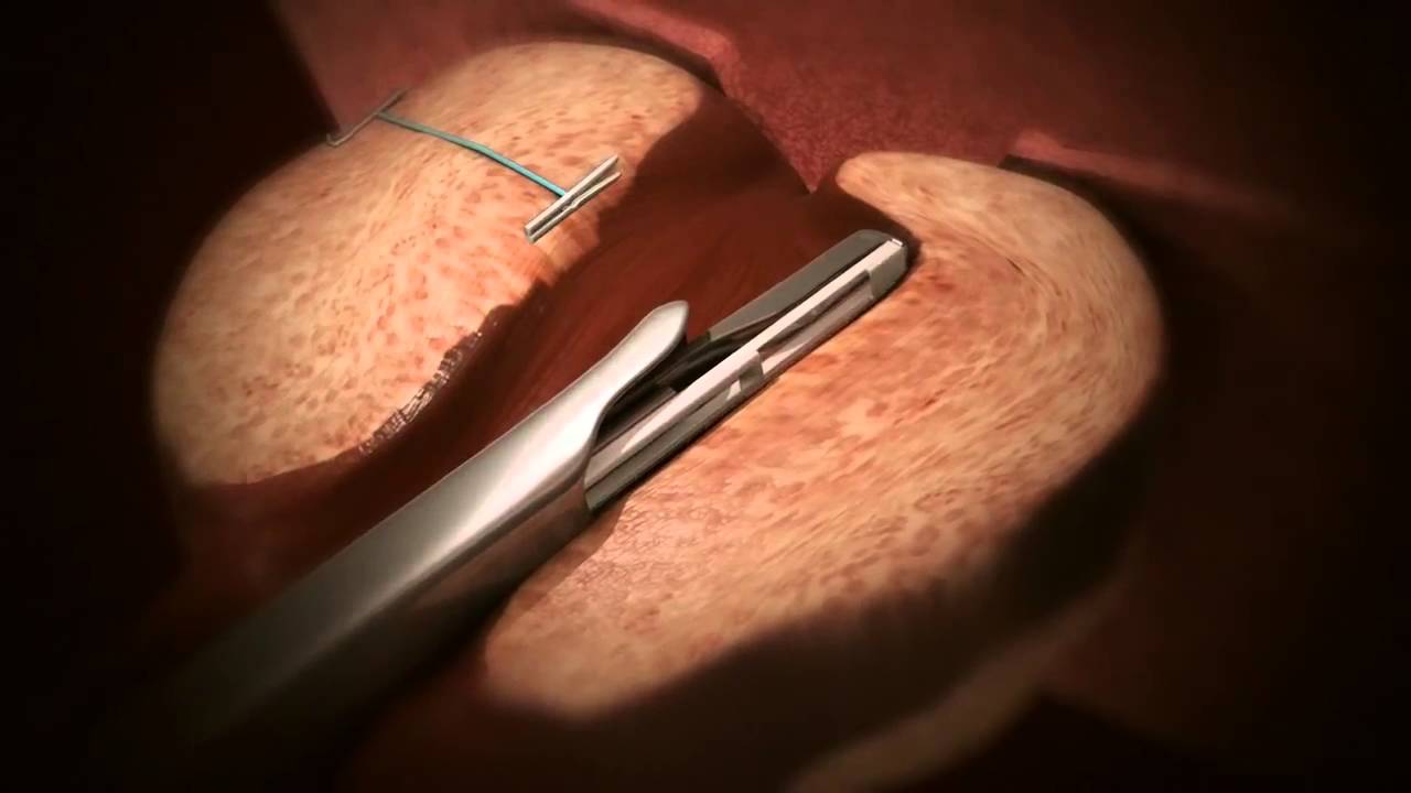 UroLift® System for BPH Procedure Animation YouTube