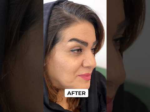 Suitable Candidate For Eyebrow Transplant  #hairtransplanthyderabad