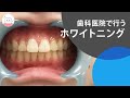 歯医者さんでしてもらうホワイトニングで元の綺麗な歯に!! Teeth Whitening From the Dentist!