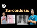Sarcoidosis (Answer to MCQ explaining Clinical features, staging, Diagnosis &amp; Treatment)