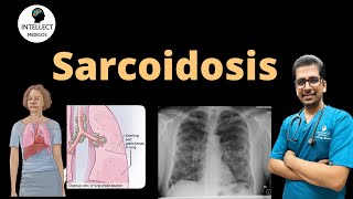 Sarcoidosis (Answer to MCQ explaining Clinical features, staging, Diagnosis & Treatment) by Intellect Medicos 2,719 views 8 months ago 12 minutes, 59 seconds