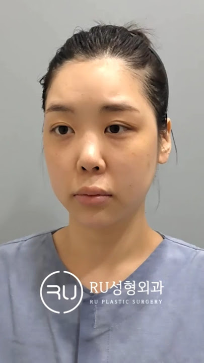 #자가늑코재수술 #코재수술 #구축코재수술 #수술전후 #수술후기 #성형전후 #beforeandafter #성형외과전문의 #알유성형외과 #김현주대표원장 #늑떼선생 #늑떼선생김현주