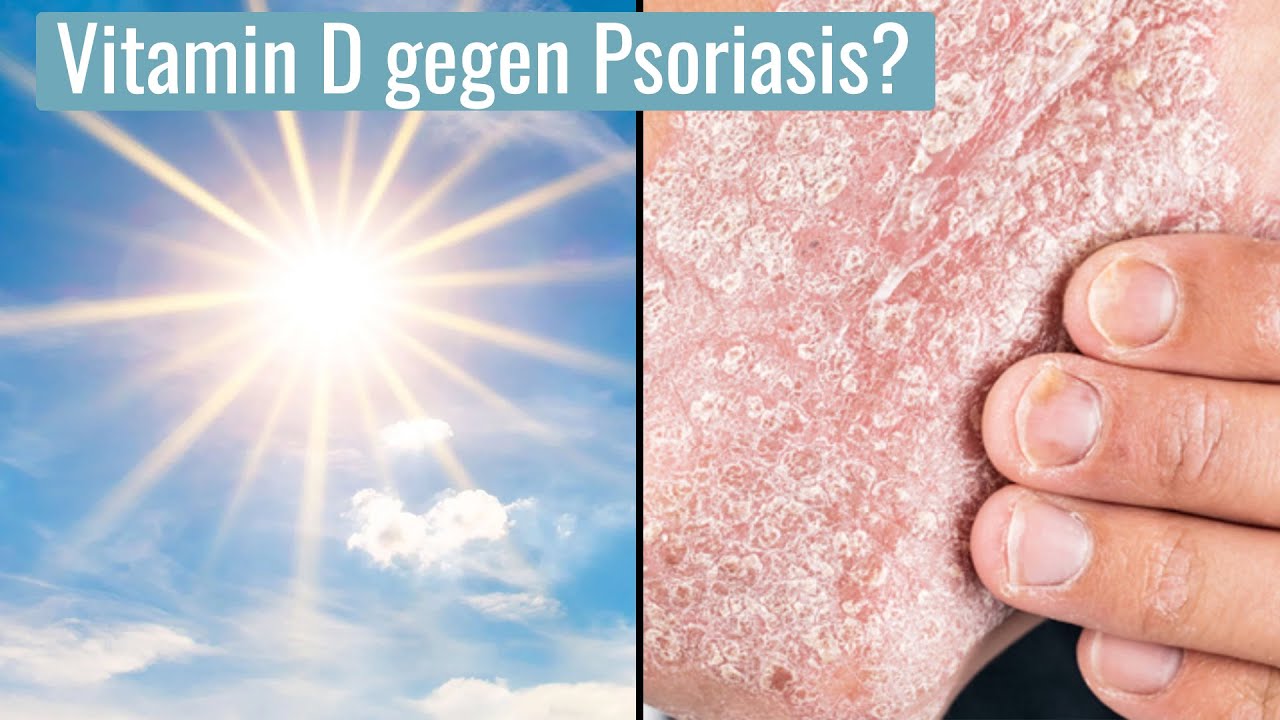 Erfahrungen Mit Vitamin D Bei Schuppenflechte www.youtube.com