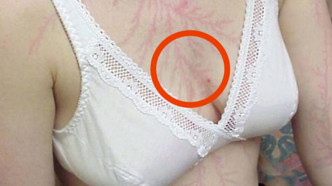 Стелла либек ожоги Стелла либек ожоги