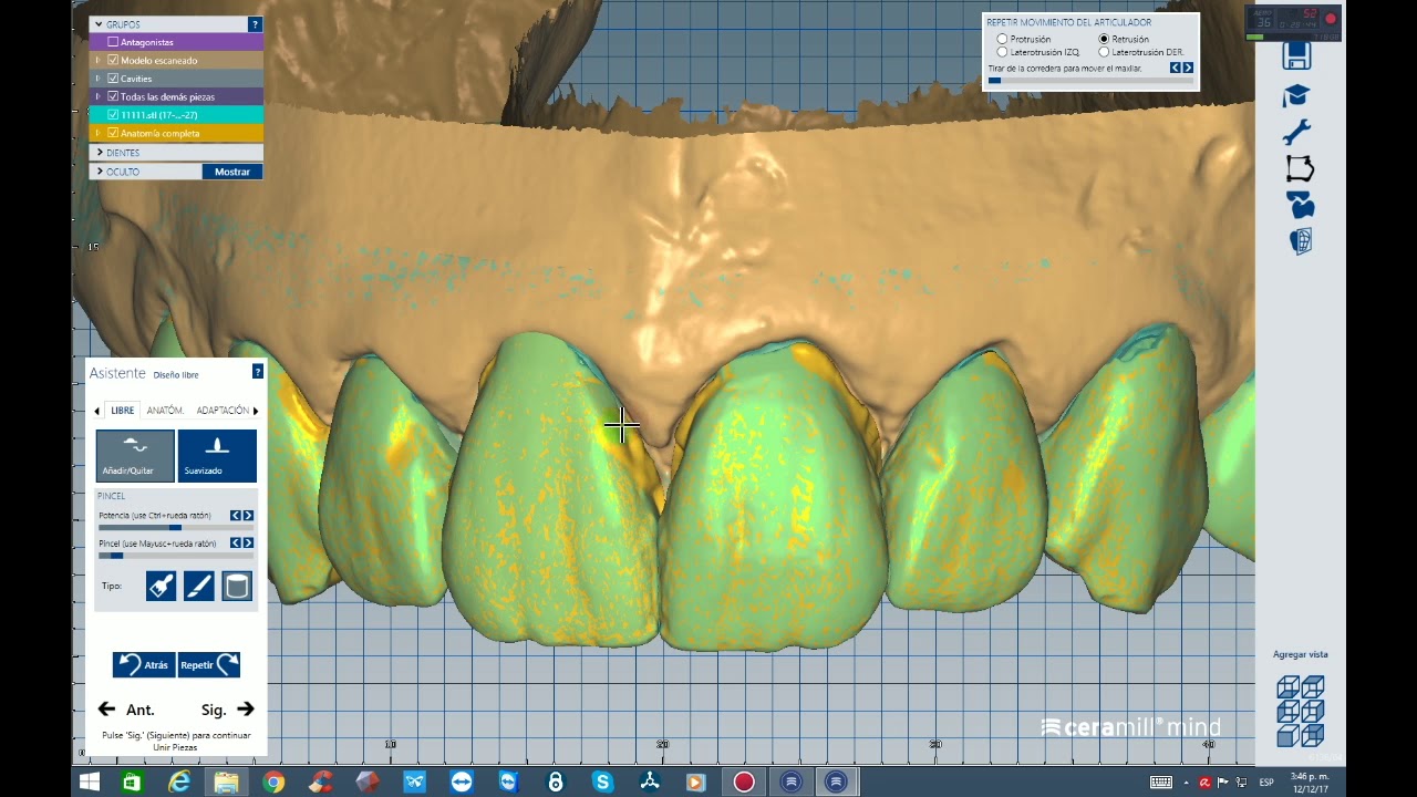 VENNERS WITH SITUATION MODEL IN EXOCAD
