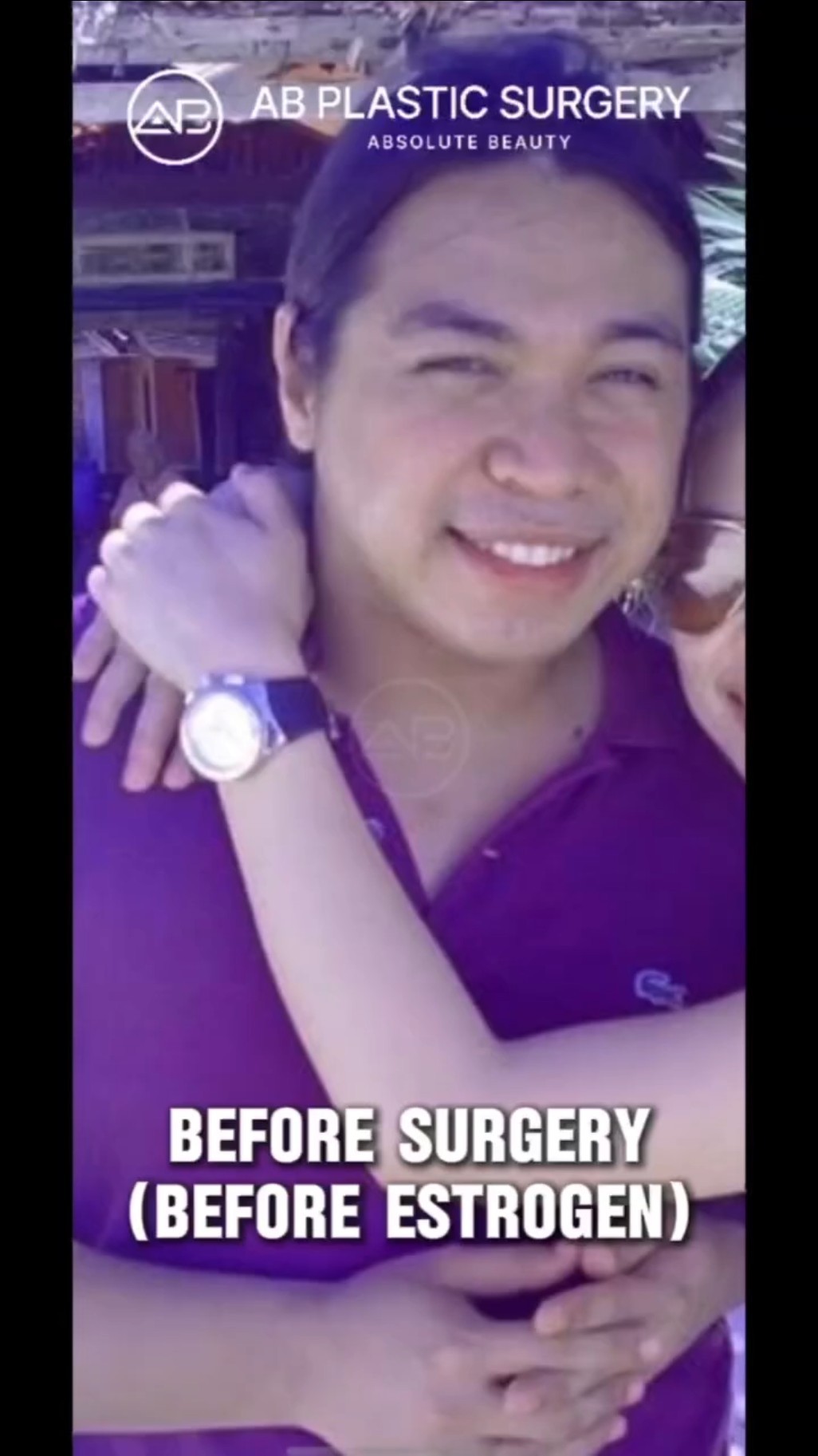 MTF Transformation: Unbelievable Facial Feminization Surgery Results! #shorts