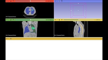 Step by Step Guide to Clean Multi Label Segmentations in 3D Slicer for Cancer Imaging Research