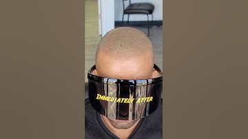 Scalp Micropigmentation