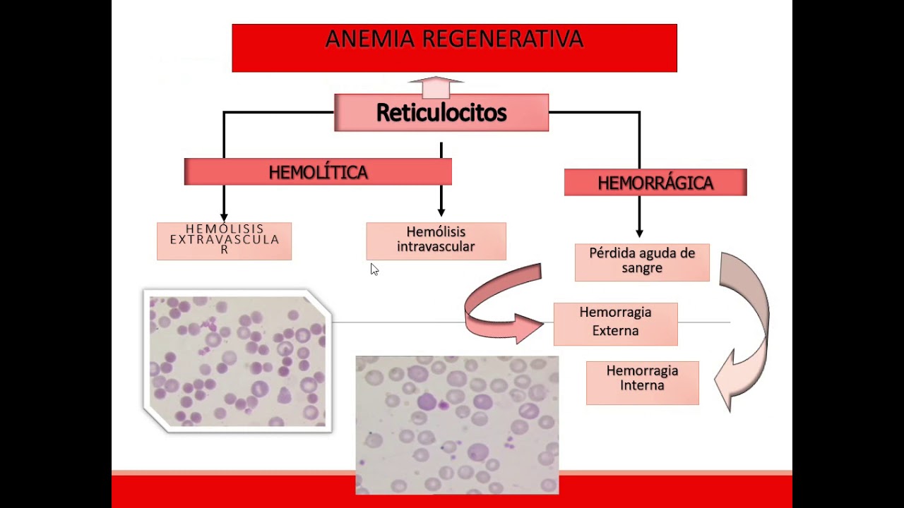 Anemie regenerativa