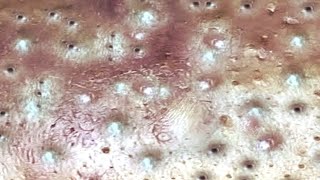 Loan Nguyen Acne Treatment 1423h