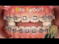 Bite turbosgeneral concepts and clinical applicationchris chang orthocc737