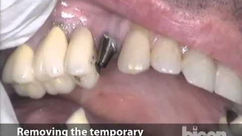 Placement of Three Bicon SHORT Implants using Inte...