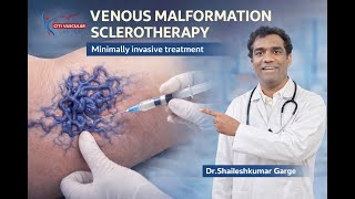 vascular speciality - Dr Shaileshkumar Garge - venous malformation sclerotherapy screenshot 5