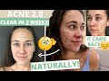 ACNE 2.0 - How to get rid of CYSTIC acne NATURALLY in TWO WEEKS!!!