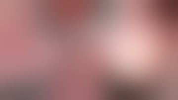 Damaged IOL exchanged from within subluxed capsular bag by Steven G. Safran MD