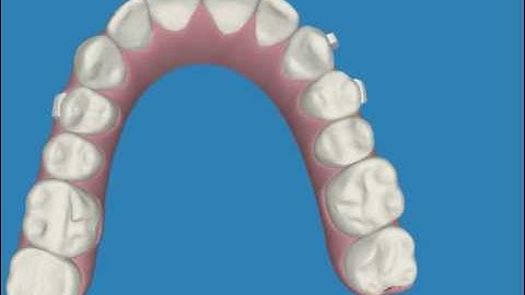 Invisalign clincheck upper arches www.myinvisalignblog.com blog