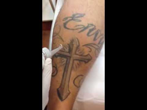 camera iphone 8 plus apk Quitar tatuajes en alicante