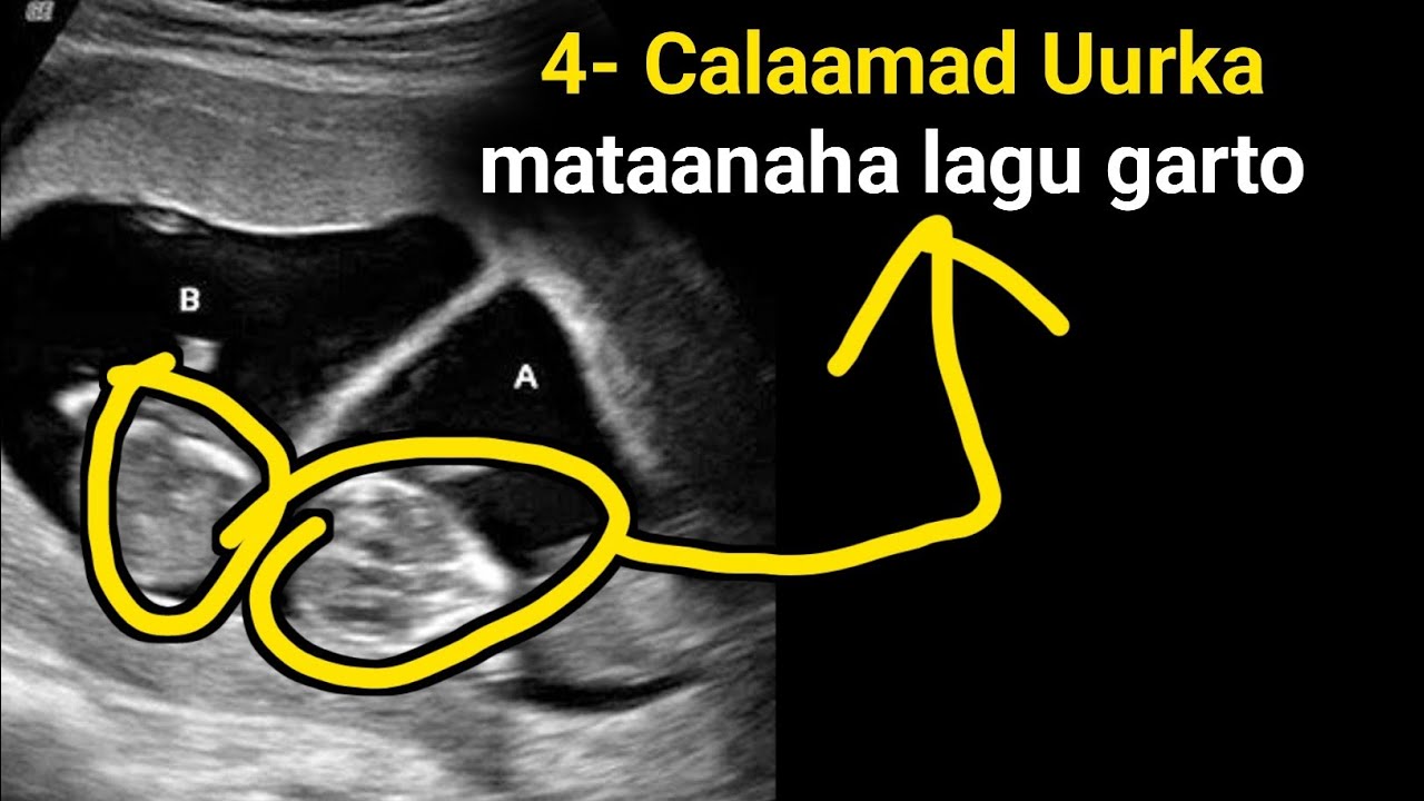 Uurka mataanaha 4-taan Calaamad ayaa lagu gartaaa marka uu...see...more.......