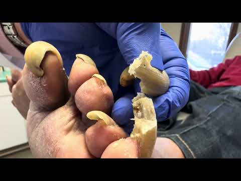 Long Rotten Toenails A Pedicure For Very Long Toenails