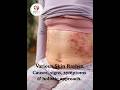 Various Skin Rashes - causes, signs, symptoms &amp; holistic approach.