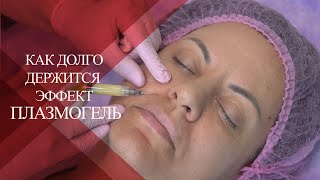 💉Контурная пластика ПЛАЗМОГЕЛЬ  | Как долго держится ЭФФЕКТ от PLASMOGEL