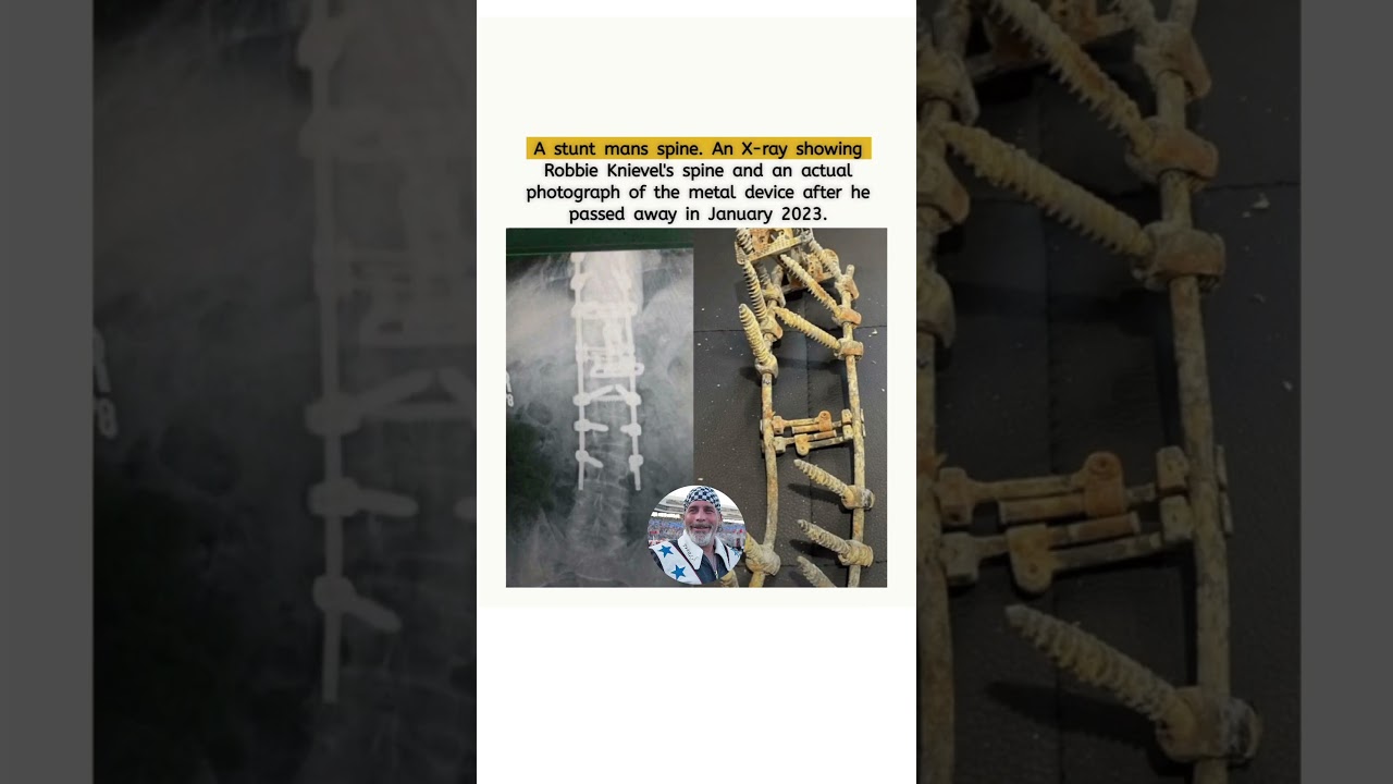 Robbie Knievel's X-ray image of his spine revealed l.