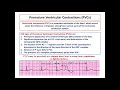 Arrhythmias