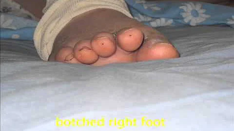 Bunion Surgery by Dr. Lawrence Silverberg DPM - Be...