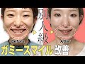 【手術なし！整形・手術なし】ガミースマイル改善♡