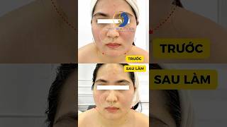 Trẻ Hoá Full Face Với Hifu Jesmas #svietspa #spauytinhanoi #beauty #lamdep #lamdepantoan #laser