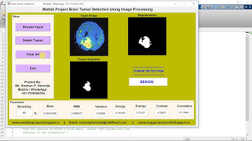 Matlab code for Brain Tumor Detection using image processing