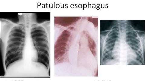 Webinar: Systemic Sclerosis, a Treatable Multi-System Disease, with Dr. Monique Hinchcliff (2012)