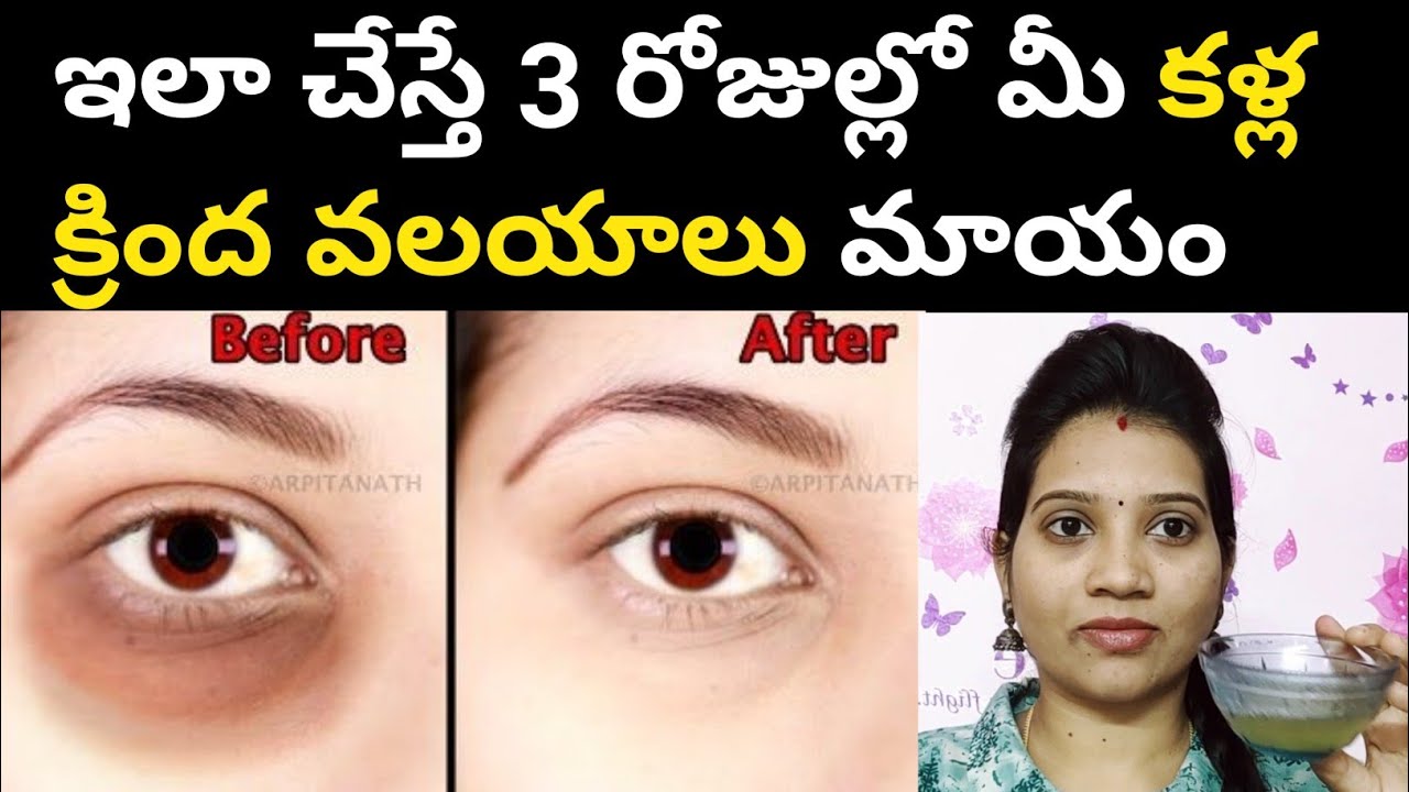 How to Remove Under Eye Dark Circles Naturally in Telugu Remove Dark