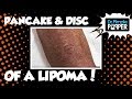 A Little Lipoma Pancake & Disc!