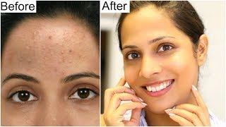 Best SKINCARE ROUTINE for Crystal Clear Skin | Shruti Arjun Anand