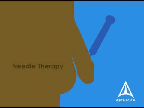 For more information about 3D medical animations, visit www.amerra.com. This patient education animation was developed to educate patients about the general effects of erectile dysfunction and how improper healthcare can increase the chance of it.