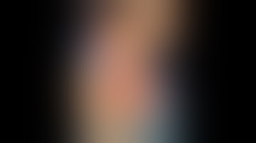 Cavus Foot Reconstruction in CMT Patient Part 2 of 2