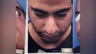 جراحی بینی در بیمار با فرم بینی ایرانی توسط دکتر باستانی نژاد | Rhinoplasty by Dr. Bastani Nejad